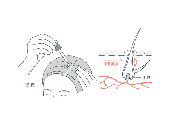 ミノキシジル外用薬の仕組み：塗布と毛包・血流への作用（頭皮断面図）