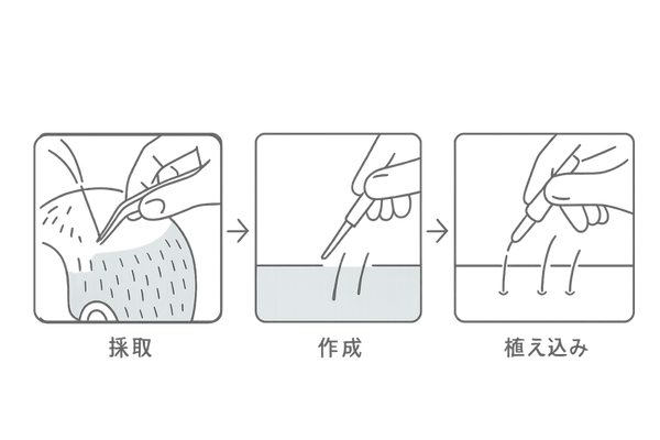 自毛植毛の施術プロセス3ステップ|採取・スリット作成・植え込みの流れ