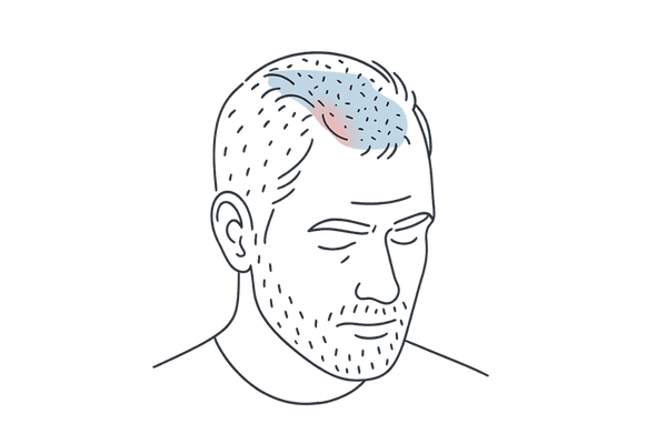 粃糠性脱毛症の特徴を表す男性頭皮のイラスト