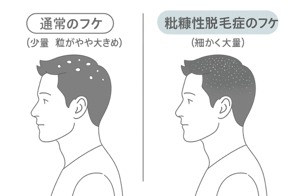 通常のフケと粃糠性脱毛症のフケの比較