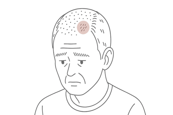 フケや炎症が進行し、脱毛が目立つようになった男性の頭皮イラスト