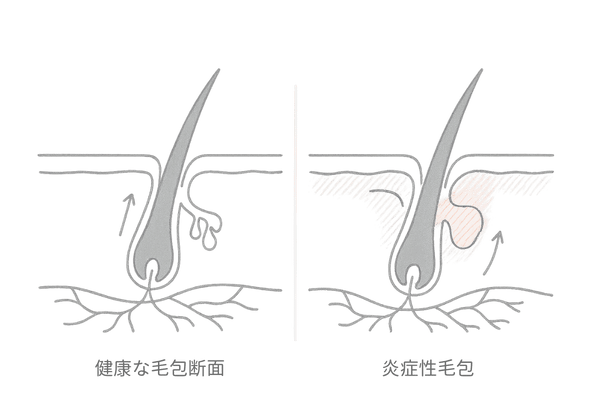 炎症が毛根に与える影響と薄毛リスク(正常毛包との比較図)
