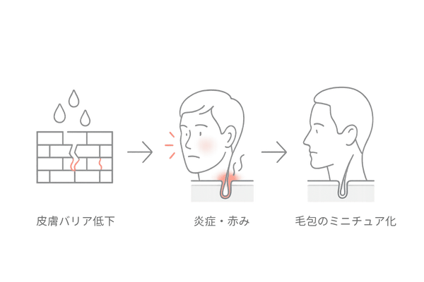 頭皮のかゆみが薄毛リスクに繋がる流れ（バリア低下→炎症→毛包のミニチュア化）