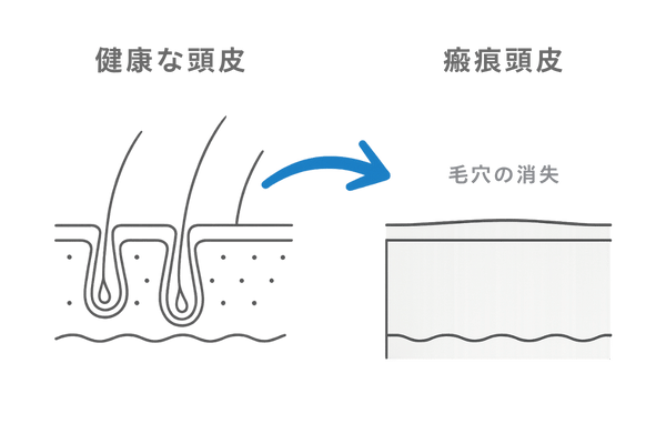 正常頭皮と毛穴が消えた瘢痕頭皮を比較した二面図