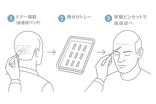 自毛植毛の採取から移植までを示す3ステップ