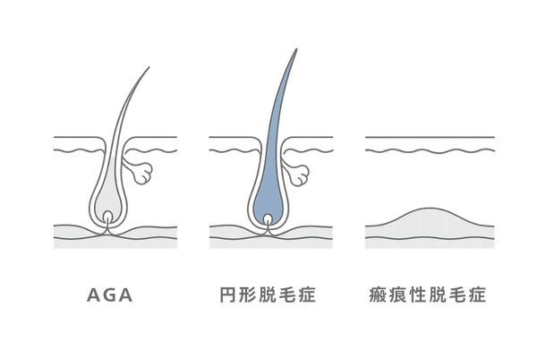AGA・円形脱毛症・瘢痕性脱毛症の毛包状態を並べて比較した図