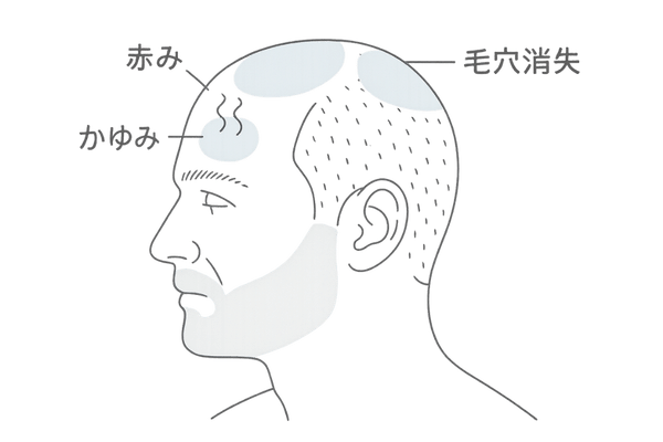 男性頭皮の赤み・かゆみ・毛穴消失を示すセルフチェック用イラスト