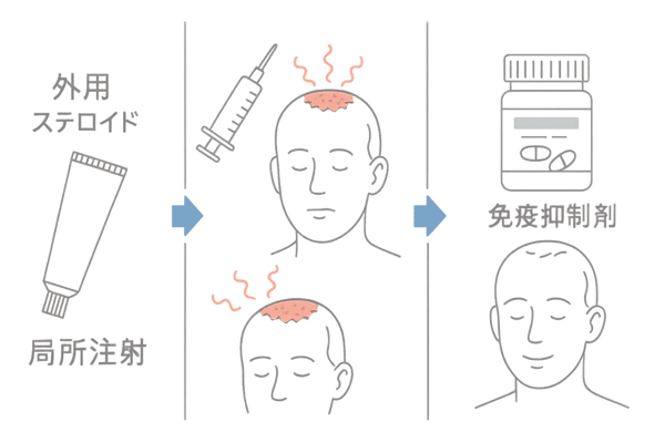 外用ステロイド・局所注射・免疫抑制剤で炎症を抑える薬物治療図