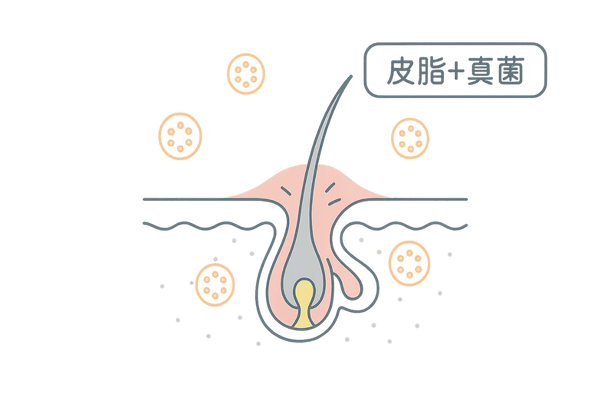 脂漏性皮膚炎の頭皮断面図｜過剰な皮脂と炎症のメカニズム