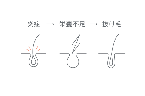 炎症が毛母細胞に与える影響フロー｜抜け毛増加の仕組み