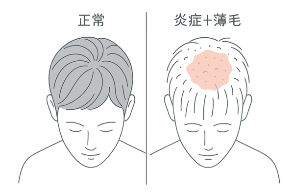 頭頂部薄毛パターン比較｜正常頭皮との違い