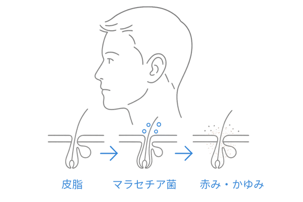 脂漏性皮膚炎の原因:皮脂過多・マラセチア増殖・炎症サイクルの図解(男性向け頭皮イラスト)