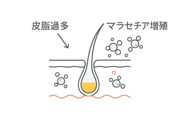 脂漏性皮膚炎の発症メカニズムを示す頭皮断面図