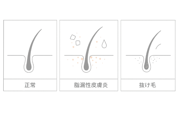 脂漏性皮膚炎による抜け毛の特徴|赤み・フケ・細い毛のイメージ図