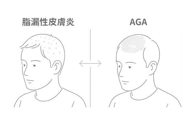 脂漏性皮膚炎とAGAの違い比較