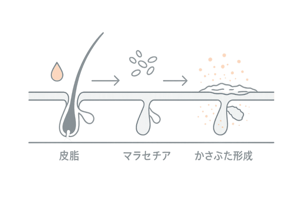 脂漏性皮膚炎で頭皮にかさぶたができるメカニズム|皮脂・マラセチア・炎症の流れ