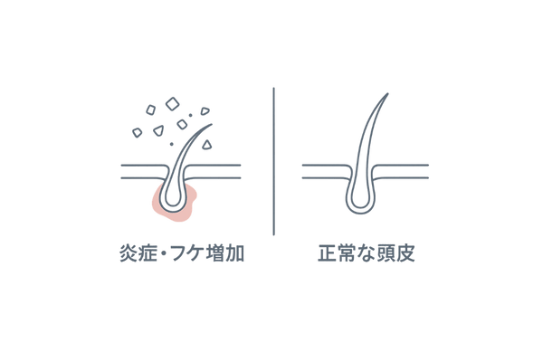 初期脱毛時に注意すべき頭皮症状イメージ