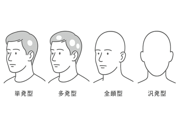 円形脱毛症の4タイプ図解