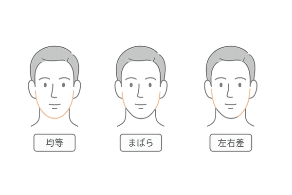もみあげ薄毛リスクを比較する線画イメージ