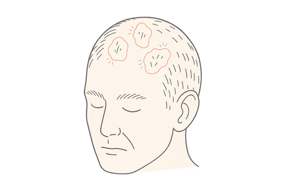 抜毛による頭皮の脱毛斑や炎症