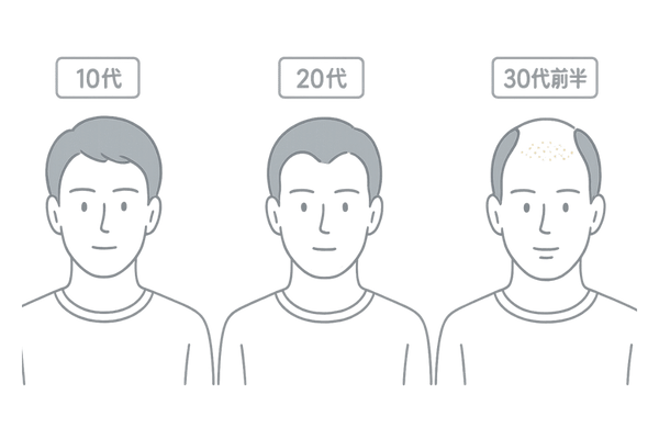 若年性の薄毛とは|10代・20代・30代の年齢別イメージ