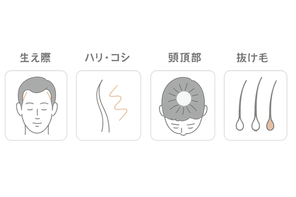 若ハゲの前兆チェック|生え際・髪質・頭頂部・抜け毛の変化