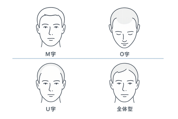 20代の若ハゲ・脱毛パターン(M字/O字/U字/全体型)セルフチェック図
