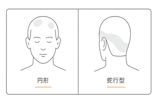 蛇行型脱毛症と円形脱毛症の違いを示すイラスト|帯状脱毛と円形斑の比較