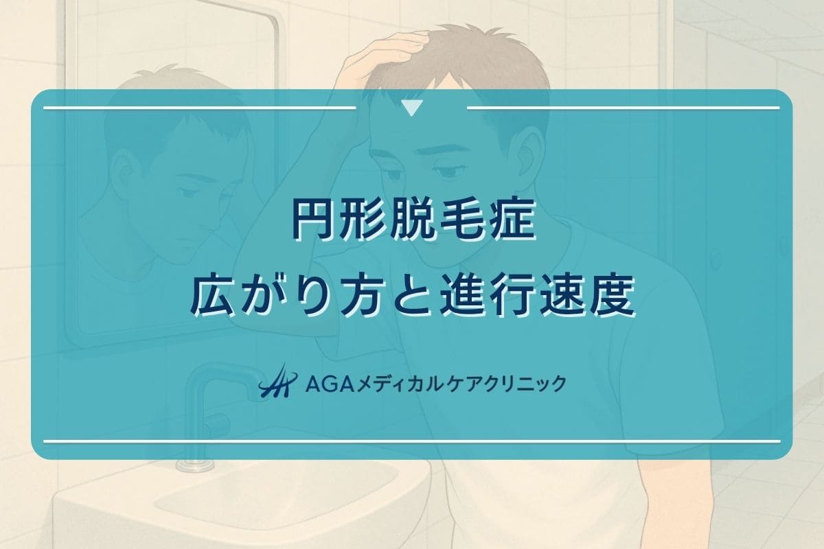 円形脱毛症 広がる、円形脱毛症 広がる 原因、円形脱毛症 進行 速度