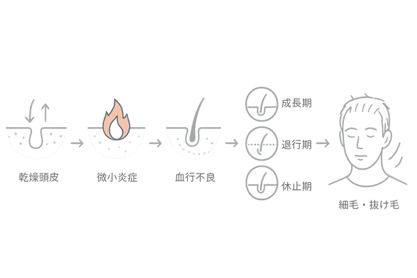 頭皮乾燥から薄毛へ進む5ステップ(炎症・血行不良・毛周期短縮)