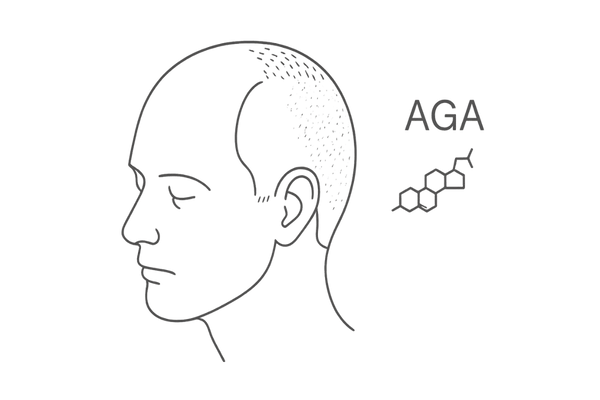 AGA(男性型脱毛症)