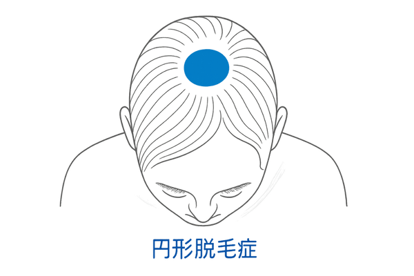 円形脱毛症