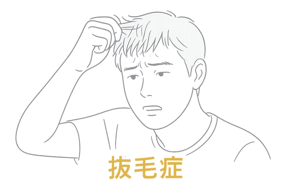 抜毛症(トリコチロマニア)