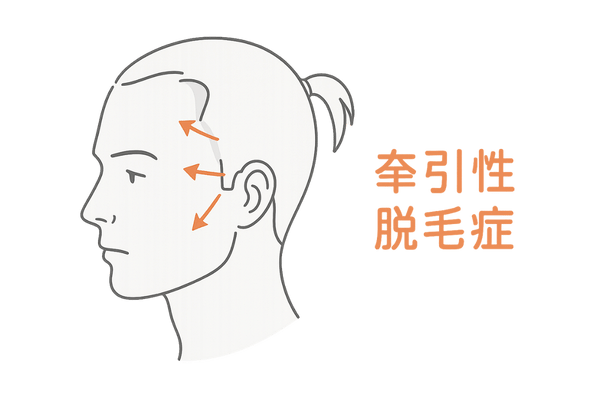 牽引性脱毛症
