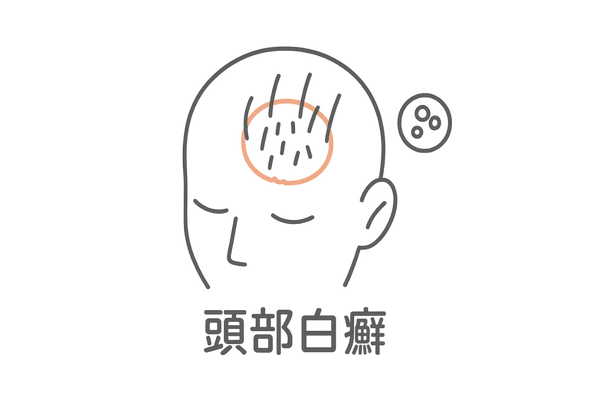 頭部白癬性脱毛症(しらくも)