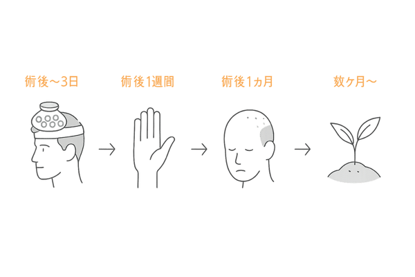 増毛手術の術後ダウンタイムと経過｜注意期間のタイムライン