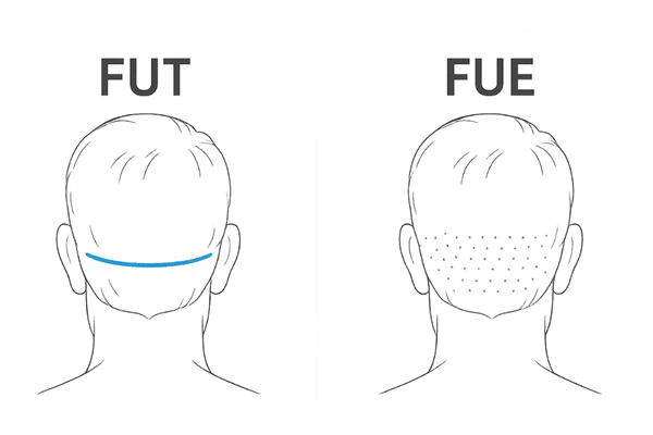 FUTとFUE採取部位比較