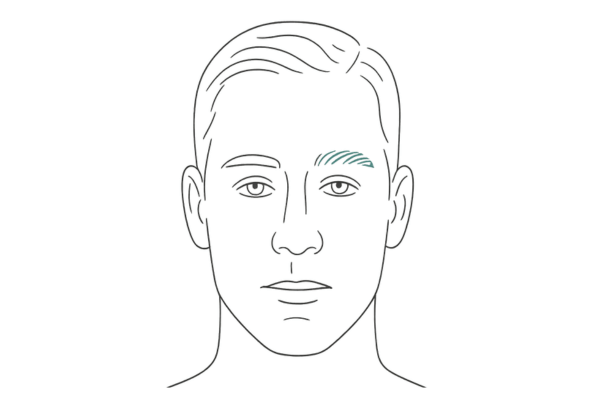 外側の眉毛が薄くなる梅毒性脱毛症の例