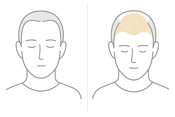 牽引性脱毛症とAGAの違い｜薄くなる部位の比較イラスト（前髪・生え際／前頭部・頭頂部）