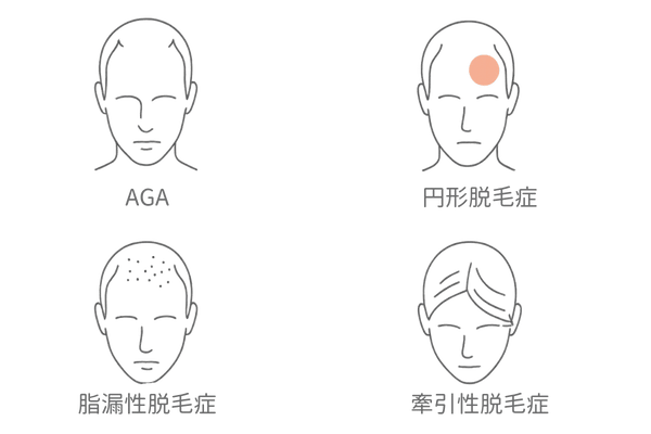 AGAと他の脱毛症の違い|円形・脂漏性・牽引性との比較図