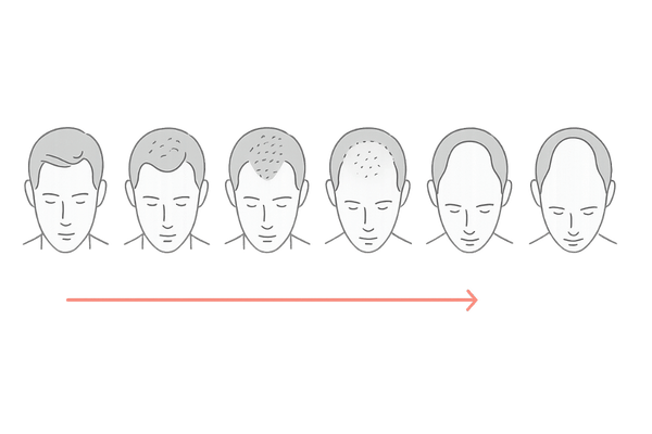 AGAのハミルトン・ノーウッド分類(レベルⅠ〜Ⅶ)図解|進行度の見た目比較
