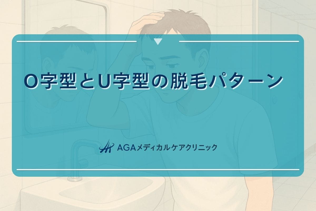 o字 はげ, u字 はげ, o型 ハゲ