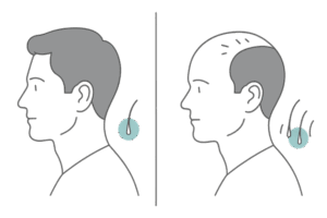 はげの進行について|初期症状から進行段階まで | 薄毛(AGA)の原因・検査ならAGAメディカルケアクリニック