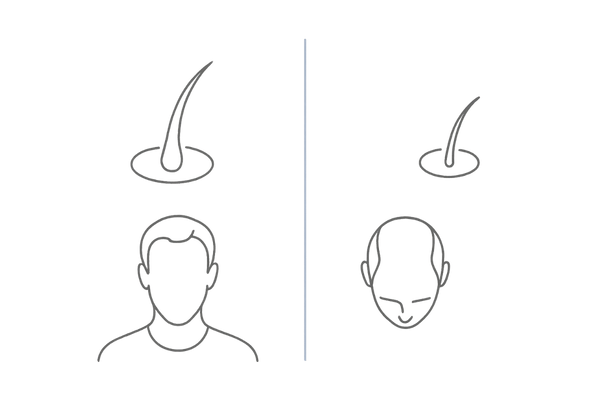 AGAセルフチェック：抜け毛の質とM字/頭頂部の薄毛サイン（図解）