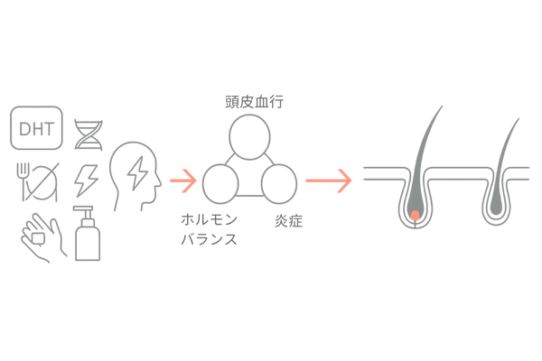 抜け毛の主な原因→毛包ミニチュア化の流れ|AGA・生活習慣・ストレス・誤ケア