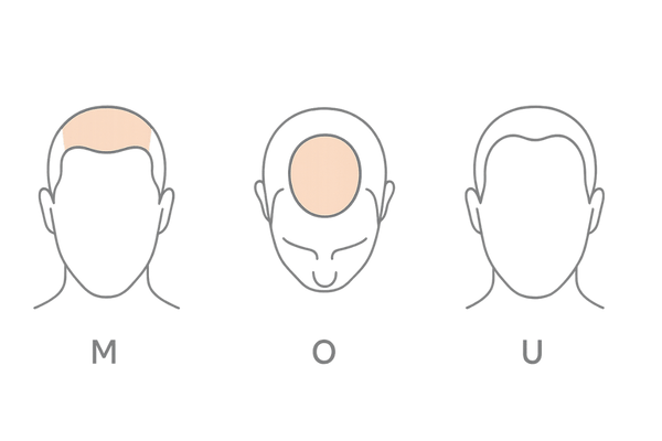 AGAの進行パターン3タイプ(M字・O字・U字)の図解|はげ方の違いが一目でわかる