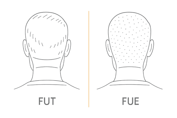 FUEとFUTの後頭部の傷跡比較|点状と線状の違いが一目でわかる図(植毛の傷跡解説)