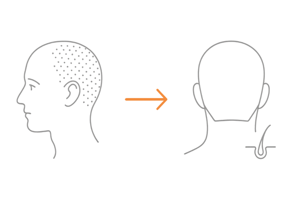 後頭部は薄毛になりにくい理由|DHTと5αリダクターゼ分布のイメージ