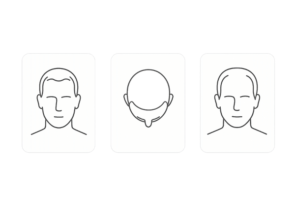 高校生の若年性AGAの進行パターン（M字・O字・U字）を示す比較イラスト