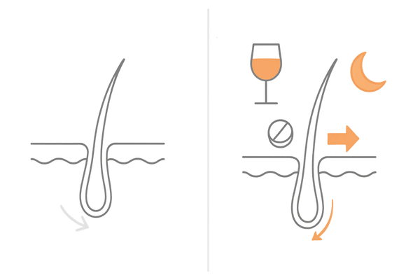 AGAと飲酒の関係：直接原因はなし、間接要因で進行が加速する比較図